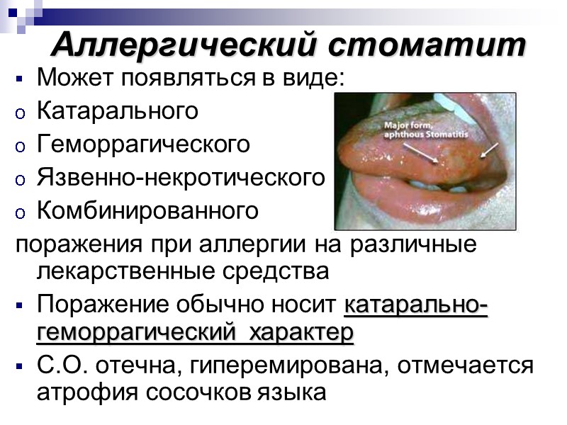 Аллергический стоматит Может появляться в виде: Катарального Геморрагического Язвенно-некротического Комбинированного  поражения при аллергии